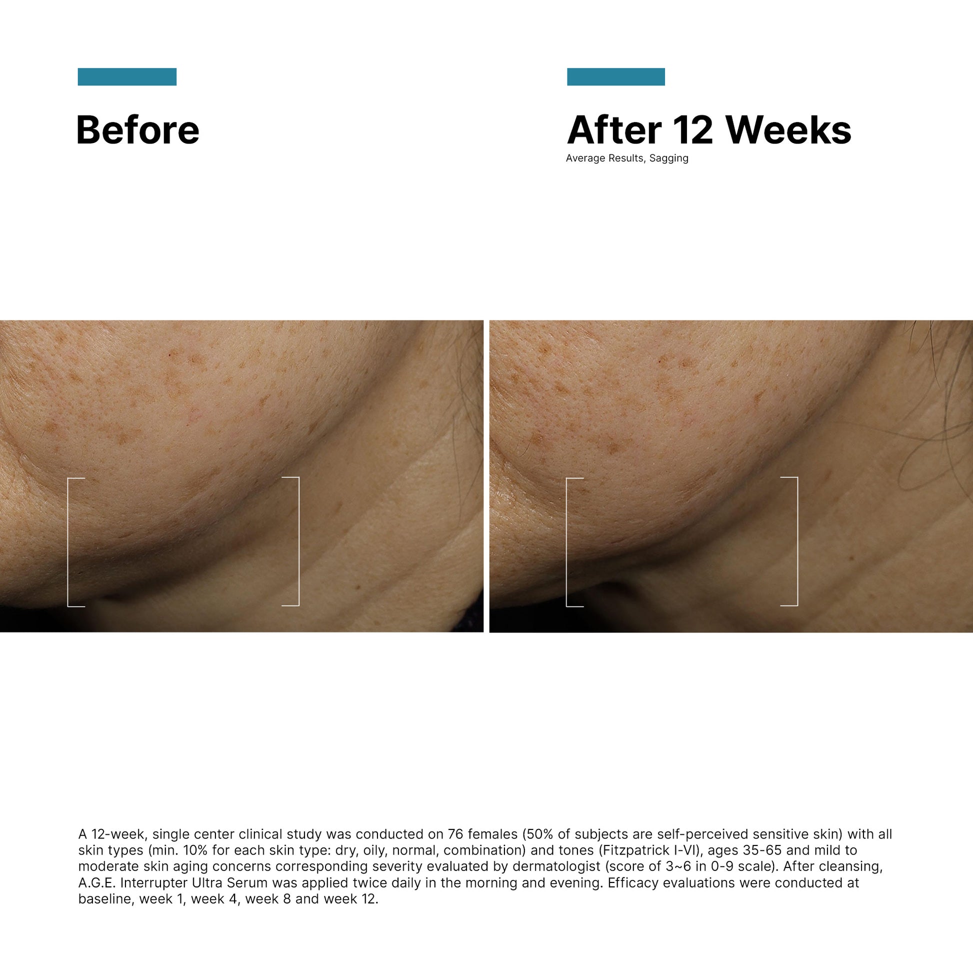 Before and after comparison of skin texture with text indicating results after 12 weeks.