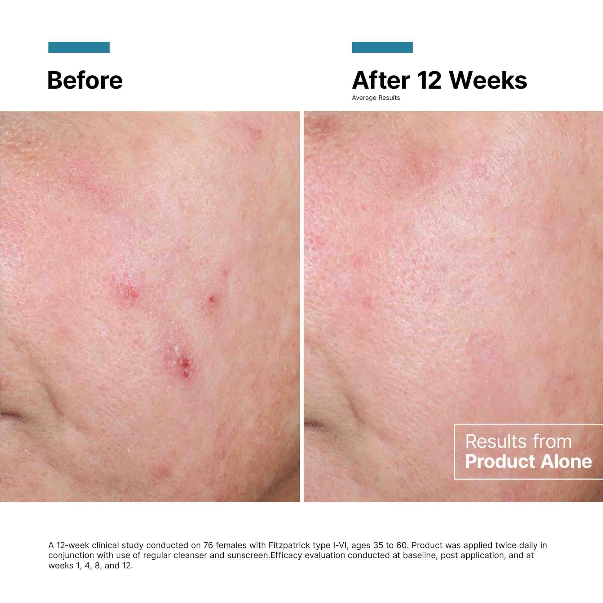Before and after comparison of skin treatment results on a person's shoulder.