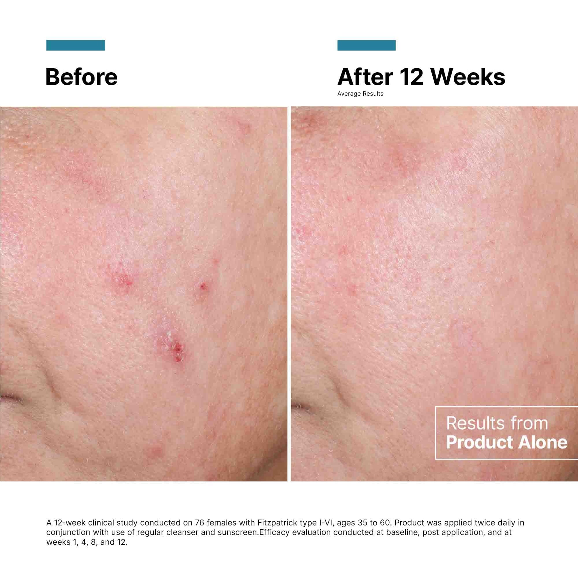 Before and after comparison of skin treatment results on a person's shoulder.