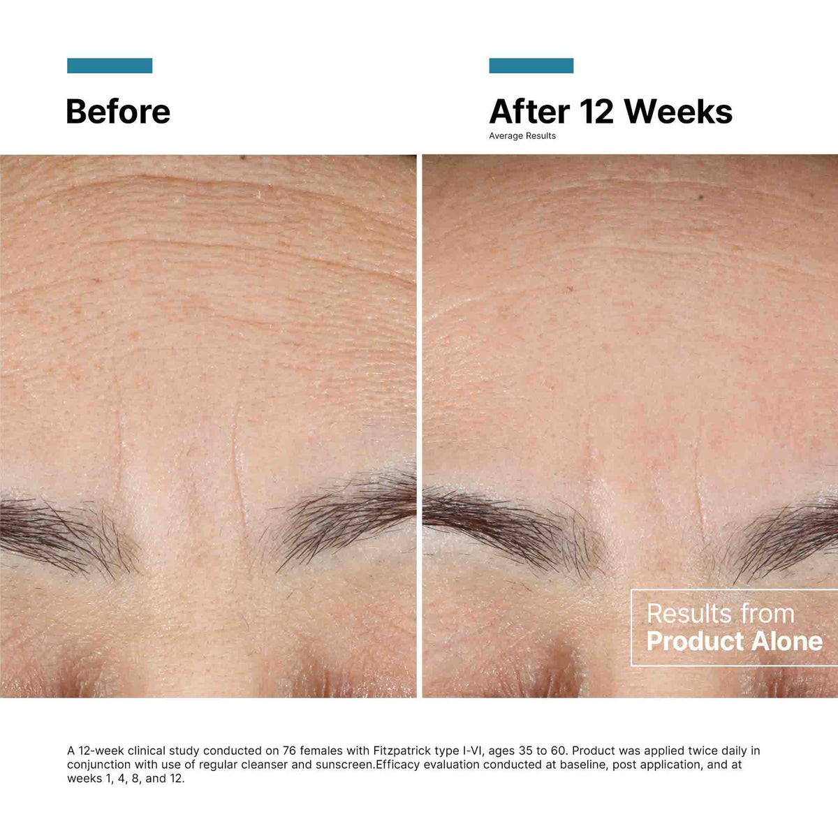 Before and after comparison of skin texture and lines on a face, showing results from a product application over 12 weeks.