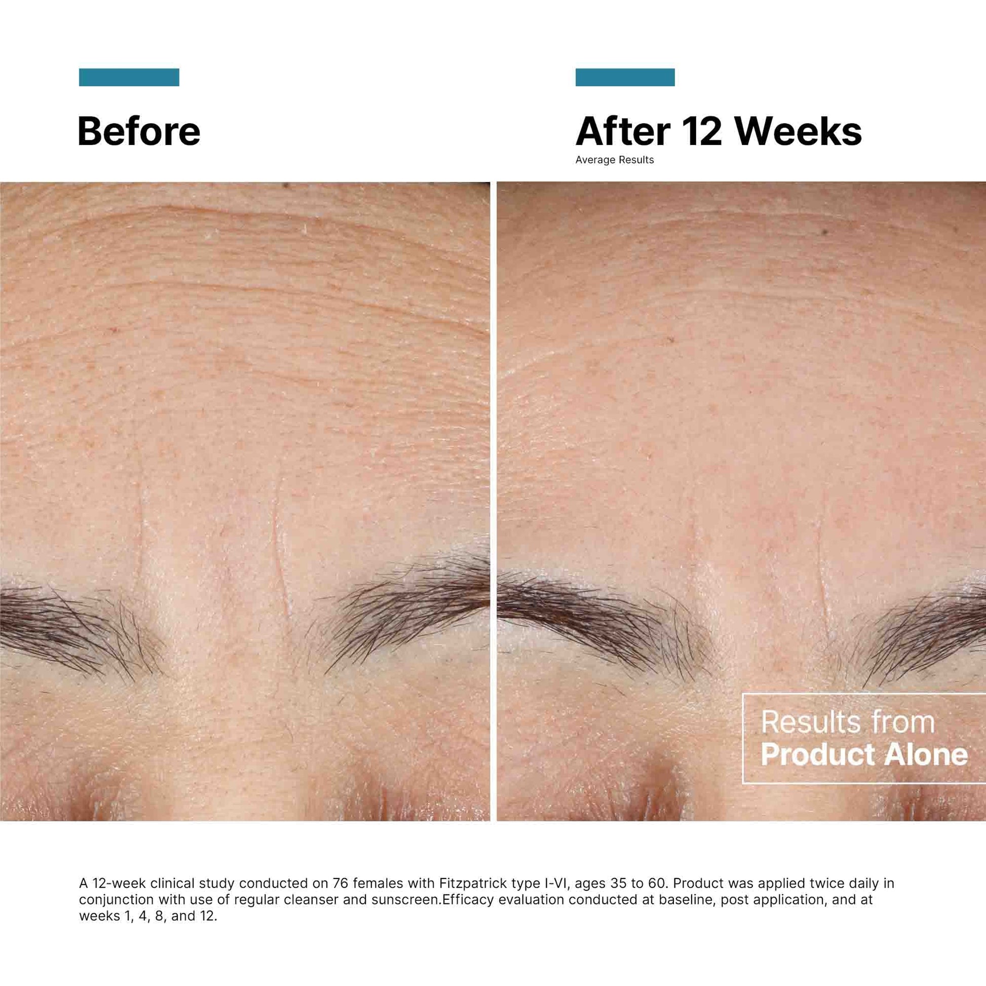 Before and after comparison of skin texture and lines on a face, showing results from a product application over 12 weeks.