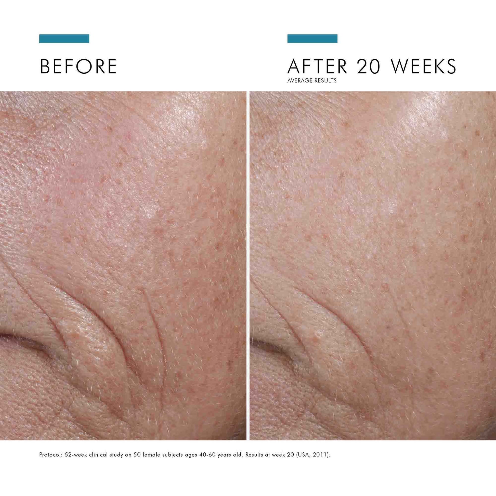 Before and after comparison of skin texture improvement over 20 weeks.