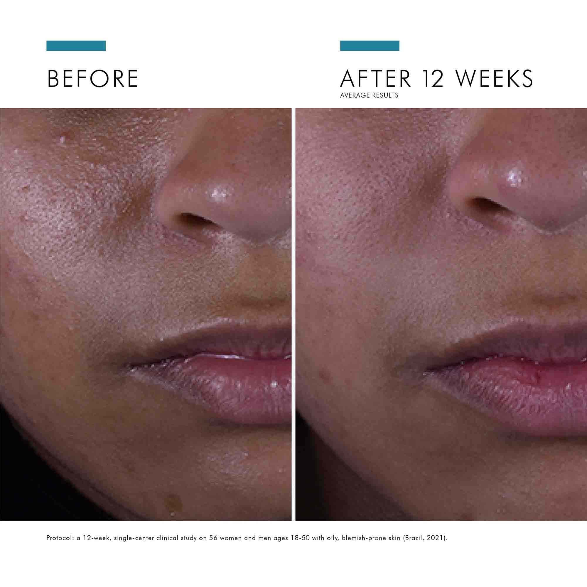 Silymarin_CF_after 12 weeks