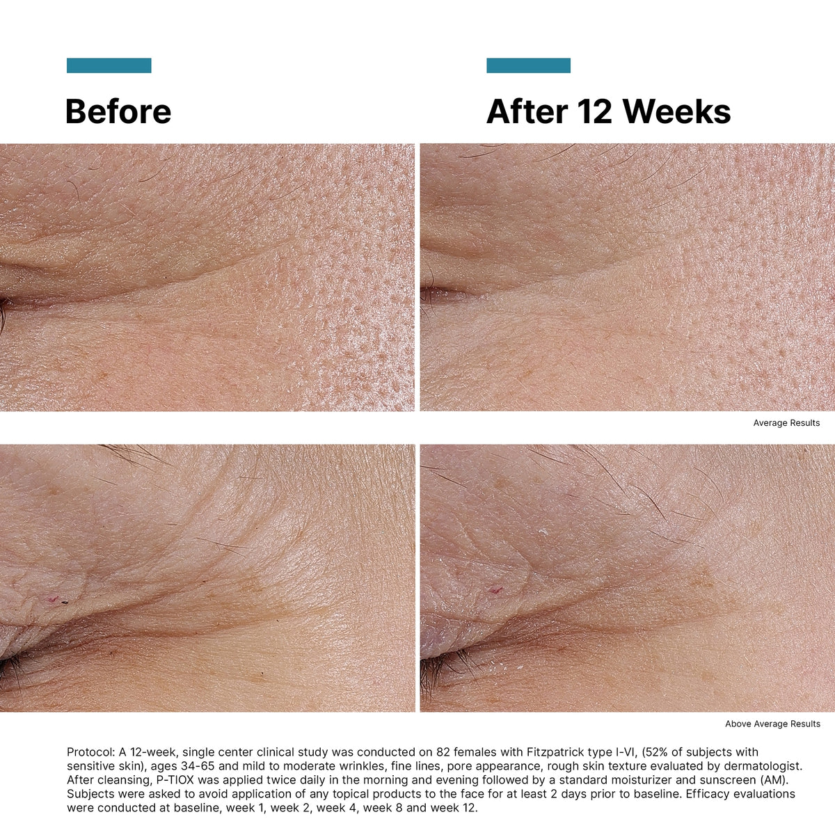 Before and after comparison of skin texture with text indicating results after 12 weeks.