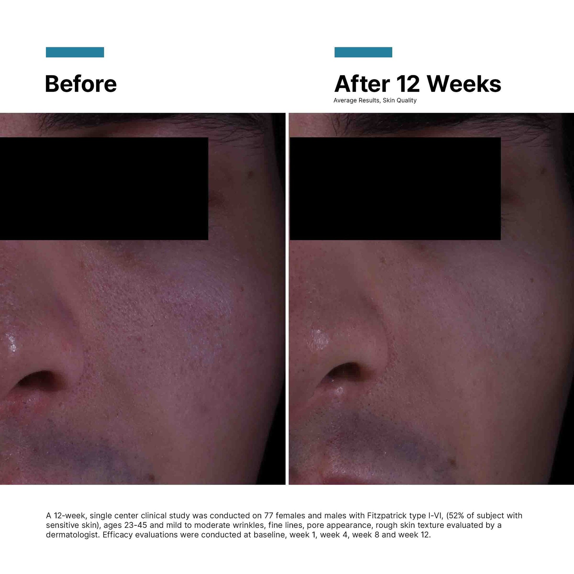 Before and after comparison of skin treatment on a person's nose, showing improvement over 12 weeks.