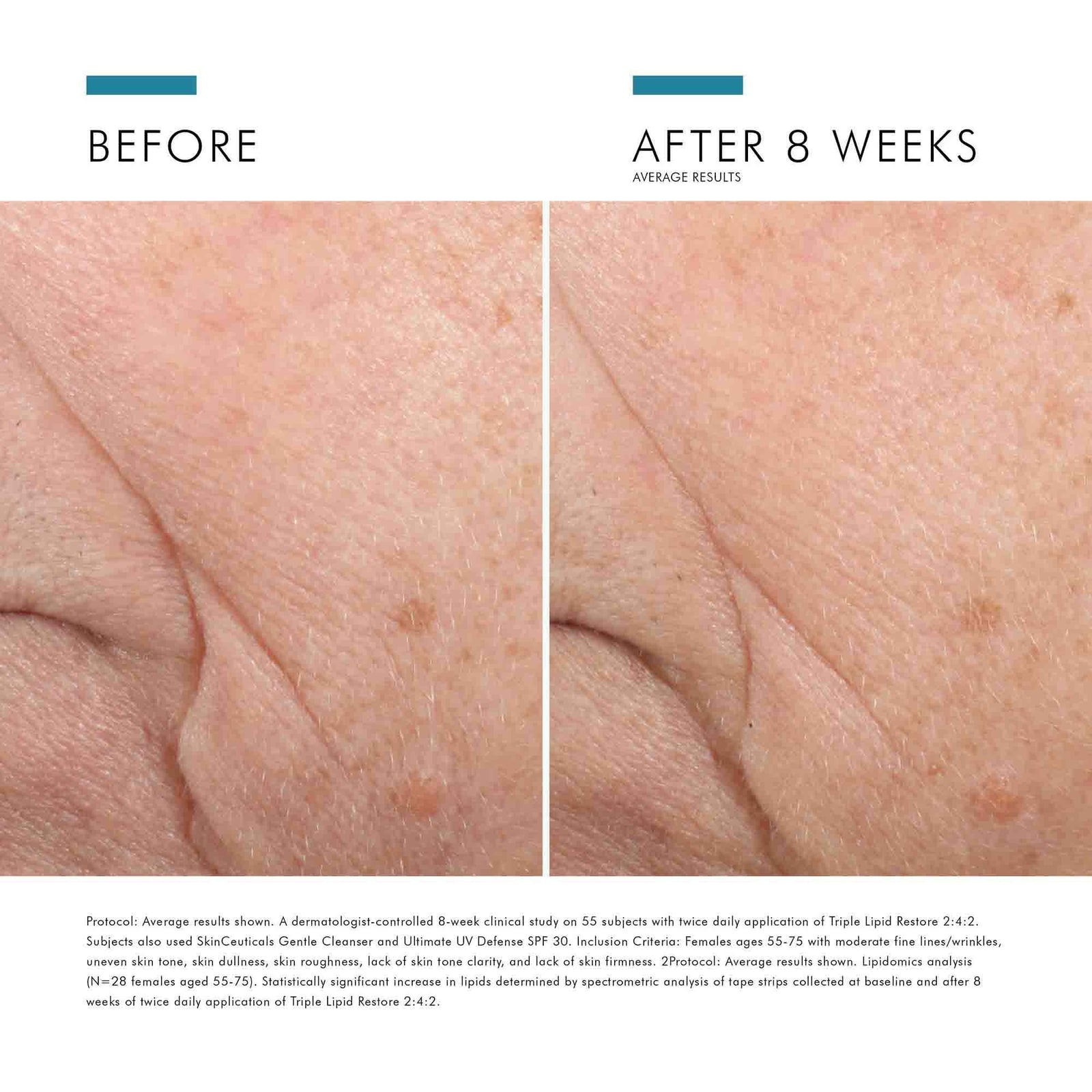 Before and after comparison of skin treatment showing reduced blemishes on a person's neck.