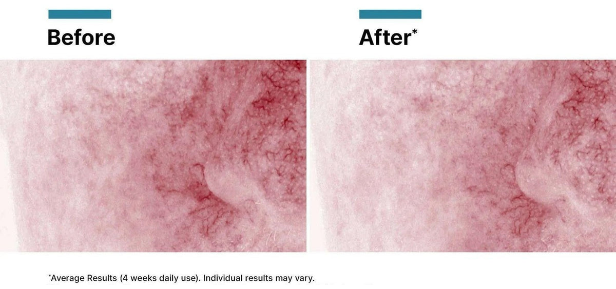 Before and after four weeks, redness, SkinCeuticals clinical imagery