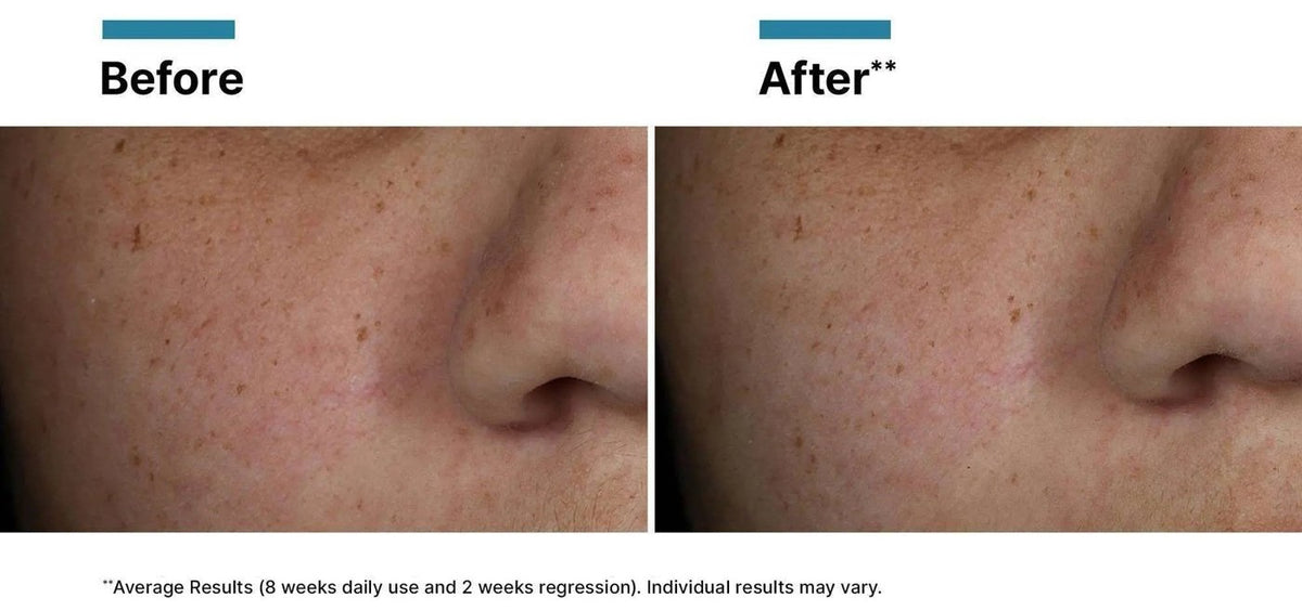 Before and after eight weeks, skin texture, SkinCeuticals clinical imagery